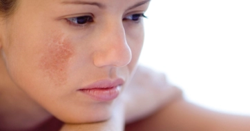 Tình trạng nám da sau sinh của phụ nữ